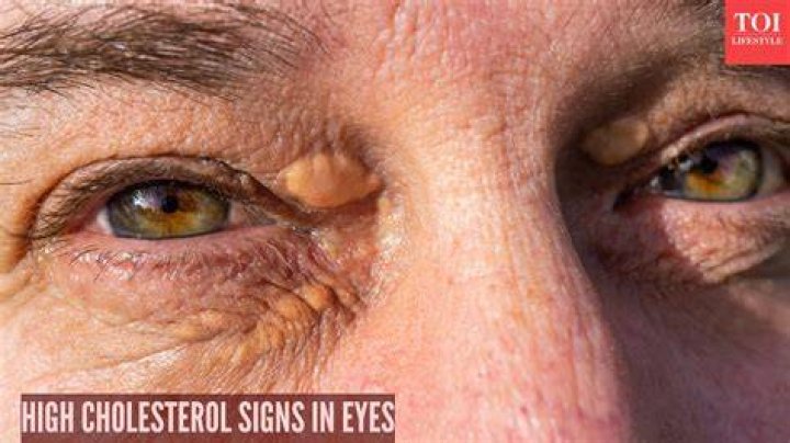 Can you tell if you have high cholesterol by your eyes?