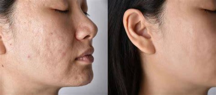 Does Curology fade acne scars?
