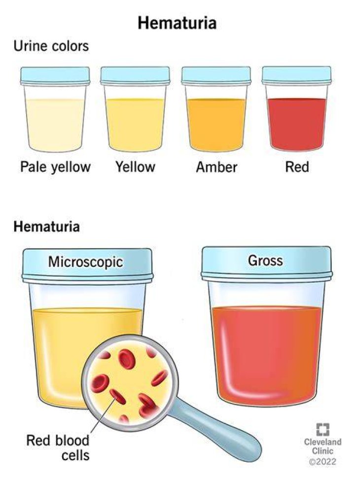 How serious is hematuria? | ContextResponse.com