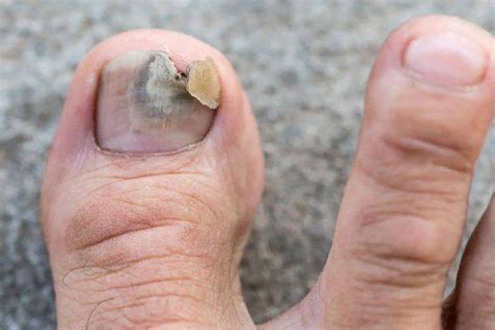 Is toenail fungus contagious? | ContextResponse.com