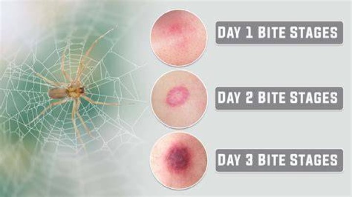 Should I drain a spider bite?