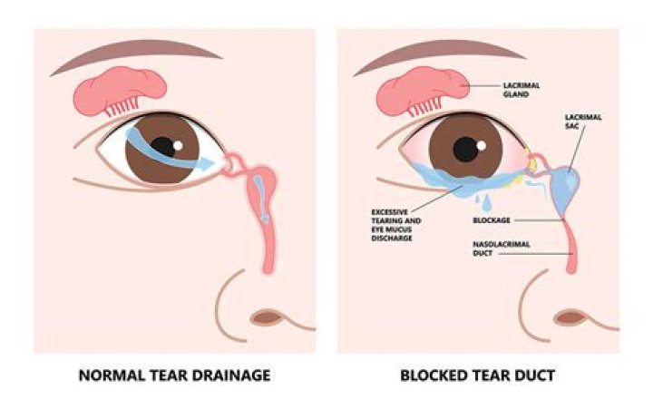 What does Dacryocystitis look like?
