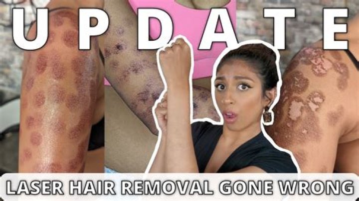 What helps burns from laser hair removal?