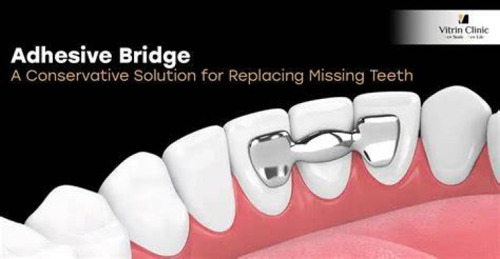 What is a adhesive bridge?