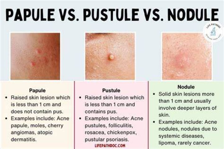 What is a nodule in the leg?