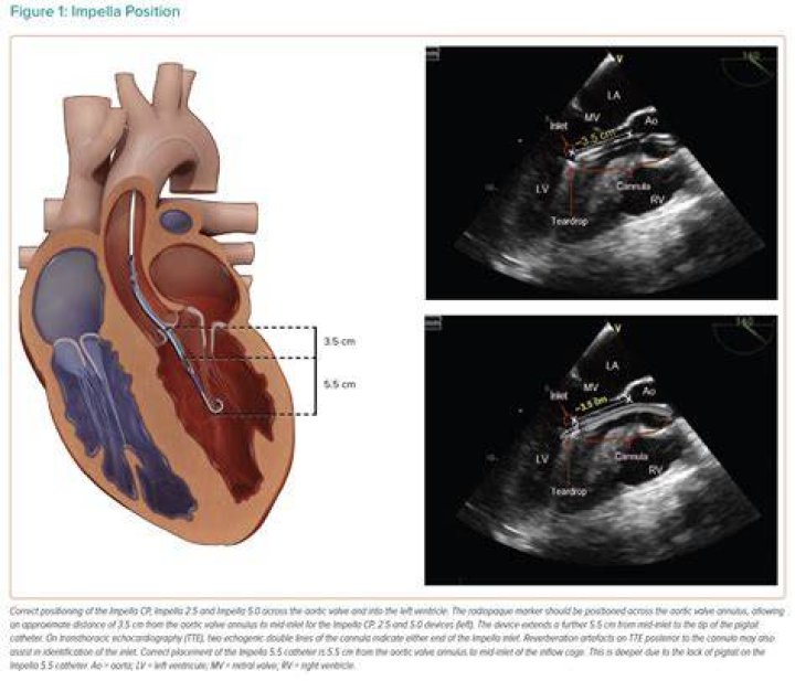 What is impella placement? | ContextResponse.com