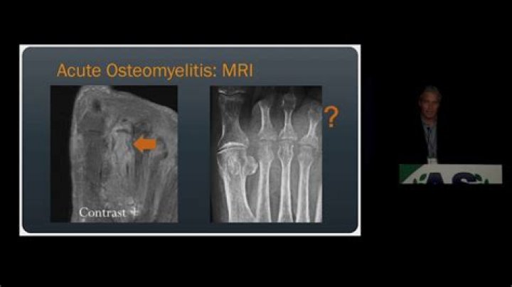 What is the best imaging for osteomyelitis?