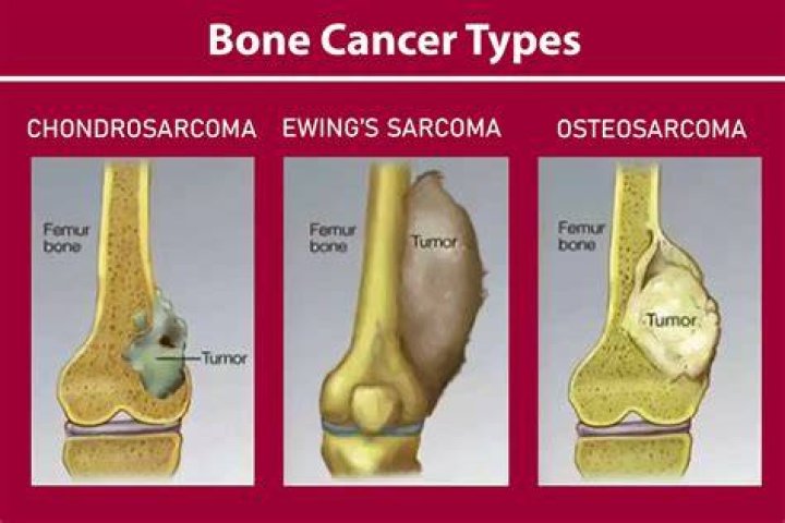 What is the most common bone tumor?