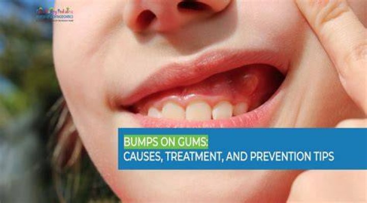Why do I have a small bump on my gums?